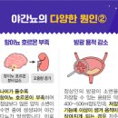 자다가 소변 야간 잦은 소변 마렵다면 이미지