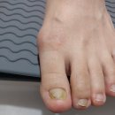 일산 가좌동 무좀발톱 케어 엄지연장 젤패디 손상된 엄지발톱 문제성 손톱 발톱 관리 후기