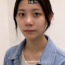 뭉툭 | [공지] 복코수술 후기｜뭉툭한 코, 무보형물 성형