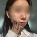 뷰티캐럿 | [뷰티] 디캐럿의원 티타늄 리프팅 후기｜울쎄라·써마지와 비교한 통증과 얼굴라인 변화
