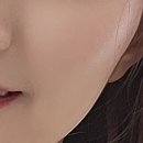 [은평 이지뷰티랩] 역촌동 기미,색소 없어지는 콜드플라즈마 후기
