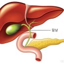 담낭염 이미지