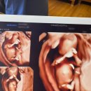 (주)아성다이소 부산화명점 | 다낭성 난소 증후군 자연임신 한 번에 성공한 이야기, 임신 초기 0~12주 기록