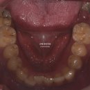 라라치과기공소 | 20대 임플란트 및 보철 후기 사진