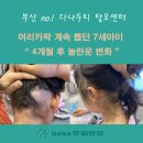 GS25사하당리점 | 부산두피 사하구다나두피에서 7세 (발모벽 )개선된 사례입니다