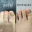 홀드핀칭 | (전주내성발톱) 서신동 ”홀드핀칭네일제작소“전주무좀발톱,전주발톱무좀