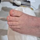 오송내성발톱 엘앤제이왁싱레푸스 문제성발톱관리하기