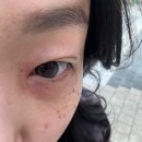 운정 피부관리 와이제이뷰티 콜드플라즈마 기미 변화 후기