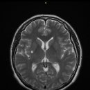 열공성 뇌경색 진단비 보험금(G46, I63, I67) 청구시 문제점과 실제 처리 사례 이미지