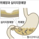 위궤양·위암 원인인 헬리코박터균, 일본처럼 무조건 제균 치료가 답일까? 이미지