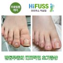 역삼에서 찾은 내성발톱 해결책, 네오네일 하이푸스 솔직후기