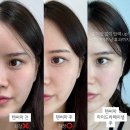 양주 옥정 피부과 :: 하이드라페이셜 + 텐써마 300샷 후기(가격, 통증, 효과, 전후사진 등)
