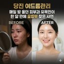 씨유만성스페이스온점 | [당진 여드름관리] 매일 밤 울던 피부과 유목민이 한 달 만에 꿀피부 찾은 진짜 사연