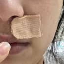 더,붙이다 | 피브로한의원 서초점 | 튀어나온 점 제거 후 재생침 2회 받은 후기