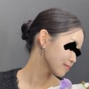 달 | 압구정로데오피부과 울쎄라 효과 통증 한달 후기