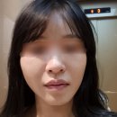 신사역 피부과 로렌의원에서 자가혈재생인자 미라젯 쥬베룩 받은 리얼 후기! (통증 없는 프리미엄 시술)