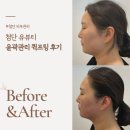 피부88뷰티 | 첨단 피부관리 유뷰티 윤곽관리 퀵프팅 관리후기