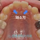 아임플란 네이버블로그