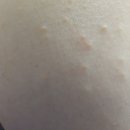 손범수달빛의원 | 수족구? 수두? 접촉성피부염? 햇빛알레르기? 청주피부과 3군데 다녀온후기