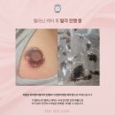 전주더멜라닌 유륜미백 엉덩이밑색소침착 겨드랑이, 팔꿈치 착색 한달차 후기 및 관리법