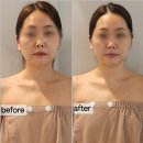 클레오파트라 | 부평 웨딩케어 추천 | 클레오파트라 작은얼굴 윤곽관리 후기