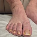 서울메디칼 | 서울 구로 발톱무좀치료 서울늘봄메디칼의원 추천합니다~~ 😊