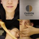 카리언뷰티클리닉 씨엘관리후기 전후 서면윤곽관리