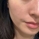 미인개 | 시청 을지로피부과 미인토닝 + 피코 골드토닝 후기