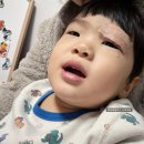 한강수병원 | 33개월 아기 눈꺼풀 찢어진 상처 봉합수술 한강수병원 치료후기