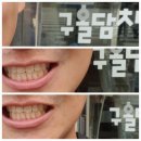 구올담치과병원 | 구올담치과에서 앞윗니 라미네이트 치료 받은 후기 3번째 라미네이트 10년만 썼으면
