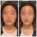 팔지천 | 강남역피부관리 | 강남뷰티 에스테틱 작은얼굴관리 시크릿매직 리얼후기 1회만에 갸름해진 얼굴