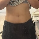 바디S | 구월동 피부과 바디온다 리프팅 S라인 주사 복부 후기