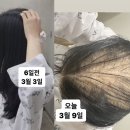 탈모+백혈구는 오르는데 호중구는 그대로 이미지