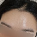 바른스킨 | 울산리투오 남구달동피부과 스킨부스터 추천 후기