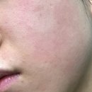 참바른약국 | 접촉성 피부염 약국 스테로이드 연고 유명템 솔직 비추후기