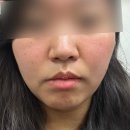 에스필의원 | 강남 예비신부 피부관리 : 쎄라덤 예스필 후기