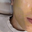 필바이오 | 청주 복대동 여드름 압출 잘하는 뉴욕비비 바이오리필(슈렉필) 후기