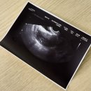 우리가축 인공수정 | 서울 아이나 여성의원 난임일기｜정재연원장님 인공수정 2회차 임신 성공 후기