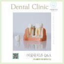 어울림치과의원 | <서초 어울림치과> 꼭 임플란트 해야 할까요? (2)