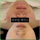 톤 에스테틱 | 청주피부관리 여드름 걱정없는 톤업에스테틱 후기