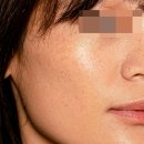 상아피부과의원 | 노원 상계동피부과 기미 잡티 제거 레이저토닝 10회 비용 효과가 달랐던 이유