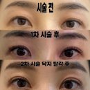 위례피부관리 플라즈마 쌍꺼풀 눈매교정 리얼후기