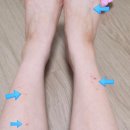 서울소망이비인후과의원 | 서울드림이비인후과 지연성알러지 검사 및 급성알러지 검사, 실비 청구 후기