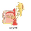 설인신경통[Glossopharyngeal neuralgia]뇌신경정신질환 이미지