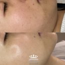 주영피부관리실 | 갈 돈 아껴주는 집에서 하는 스킨부스터 슈퍼젝션 홈키트 임상사진 + 리얼 후기 [창원・마산 슈퍼젝션]