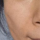 에버성형외과의원 | 라움 성형외과 루비레이저로 흑자 2차 치료 18개월 후기.3차 치료 예약 일정