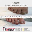 부산 무좀 발톱, 남포동 문제성발톱 레푸스 남포점 당일 관리 후기