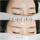 1505 | 인천부평 눈썹문신제거 딱지 진물 없이 잔흔만 쏘옥👍👍