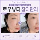 발린뷰티 | 부산 에스테틱 잡티관리 | 콜드플라즈마로 기미 제거한 로우뷰티 솔직 후기