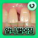 예성윤치과의원 | 동래역치과 앞니 벌어져 생긴 공간 레진치료 가능해요?